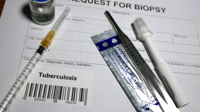 W 2025 r. Mizoram w wieku 145 lat odnotował najwyższy od sześciu lat wskaźnik zgonów na gruźlicę
| przegladursynowski.pl